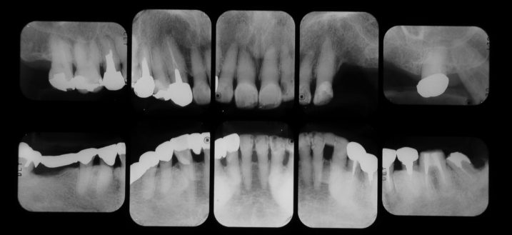 下関市のおおむら歯科医院で、セラミック、歯周外科手術、インプラントの治療を行う前のレントゲン写真