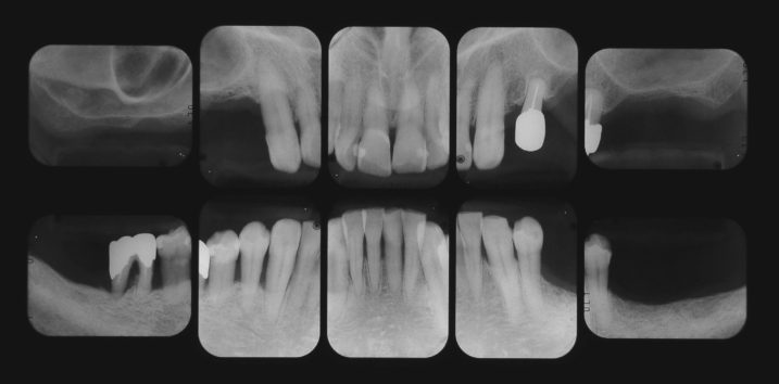 下関市のおおむら歯科医院で、インプラント、上顎洞底挙上術（サイナスリフト）を行う前のレントゲン写真。