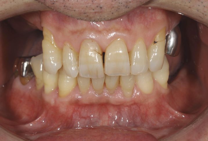 下関市のおおむら歯科医院で、インプラント、上顎洞底挙上術（サイナスリフト）を行う前の写真。