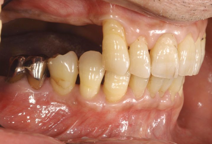 下関市のおおむら歯科医院で、インプラント、上顎洞底挙上術（サイナスリフト）を行う前の写真。右側方