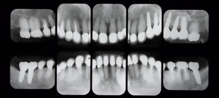 下関市のおおむら歯科医院で、セラミック、歯周外科手術、インプラントの治療を行った後のレントゲン写真