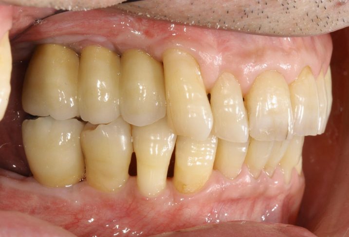 下関市のおおむら歯科医院で、インプラント、上顎洞底挙上術（サイナスリフト）を行った後の写真。右側方