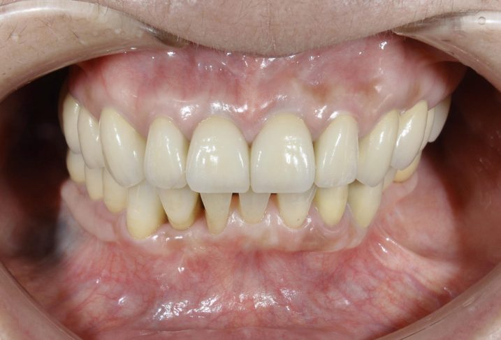 下関市のおおむら歯科医院でセラミック、インプラント、歯周病、矯正治療を行なった症例が専門誌に掲載されました。その治療後の写真です。