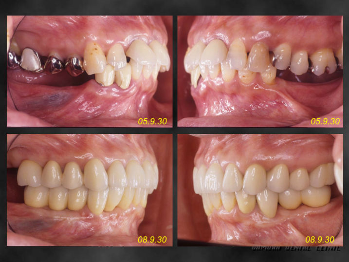 下関市のおおむら歯科医院でセラミック、インプラント、歯周病、矯正治療を行なった症例が専門誌に掲載されました。その治療前と治療後の比較写真です。