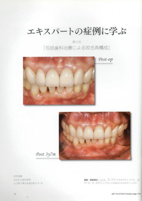 下関市のおおむら歯科医院でセラミック、インプラント、歯周病、矯正治療を行なった症例が専門誌に掲載されました。