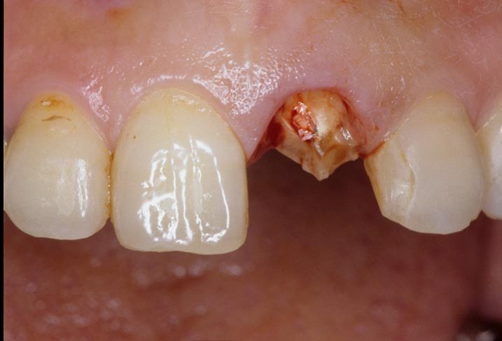 症例46 破折歯の生物学的幅径の確立と審美補綴治療 | 下関 おおむら歯科医院の症例ブログ「日々是臨床・百聞は一見に如ず」（審美歯科