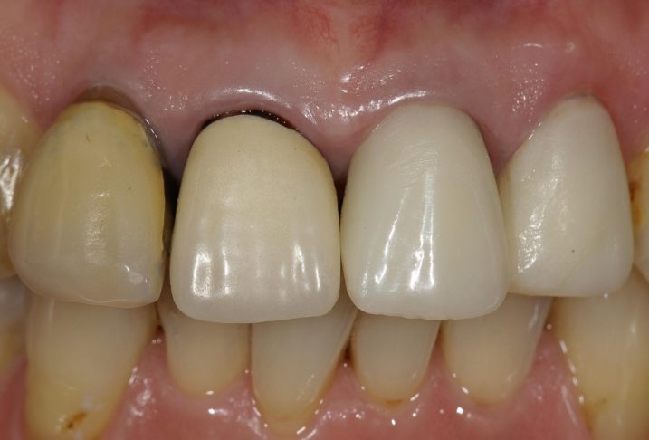 下関のおおむら歯科医院にて、上顎前歯のセラミッククラウンによる審美補綴治療を行う前の写真