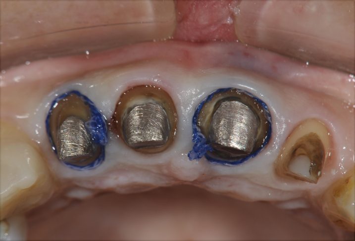 下関のおおむら歯科医院にて、上顎前歯のセラミッククラウンによる審美補綴治療を行うため、圧排操作を行なっている写真。