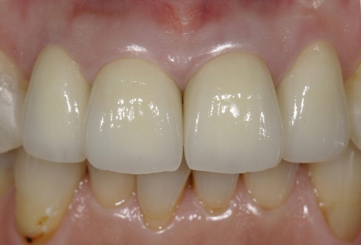 下関のおおむら歯科医院にて、上顎前歯のセラミッククラウンによる審美補綴治療を行った後の写真