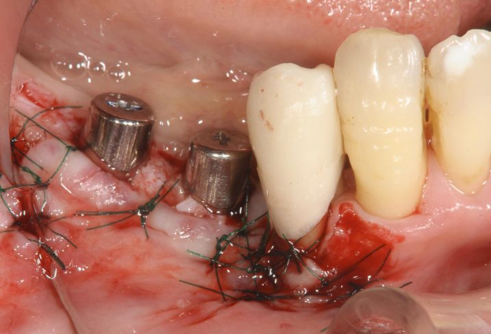 下関市のおおむら歯科医院にて左下臼歯部にインプラントとセラミックの治療を行っている写真。グラフト手術も併用し、付着歯肉幅の増大を狙った。