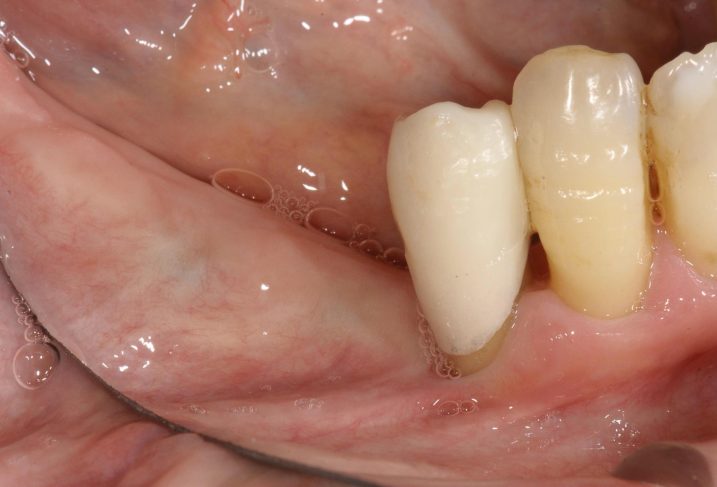 下関市のおおむら歯科医院にて左下臼歯部にインプラントとセラミックの治療を行う前の写真。