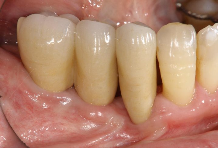 下関市のおおむら歯科医院にて左下臼歯部にインプラントとセラミックの治療を行った後の写真。