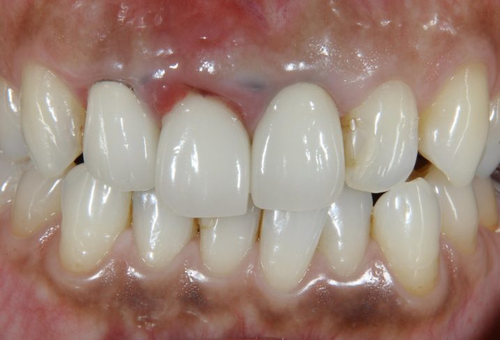 下関のおおむら歯科医院で上顎前歯部に対してセラミックとインプラントを用いた審美歯科治療を行う前の写真