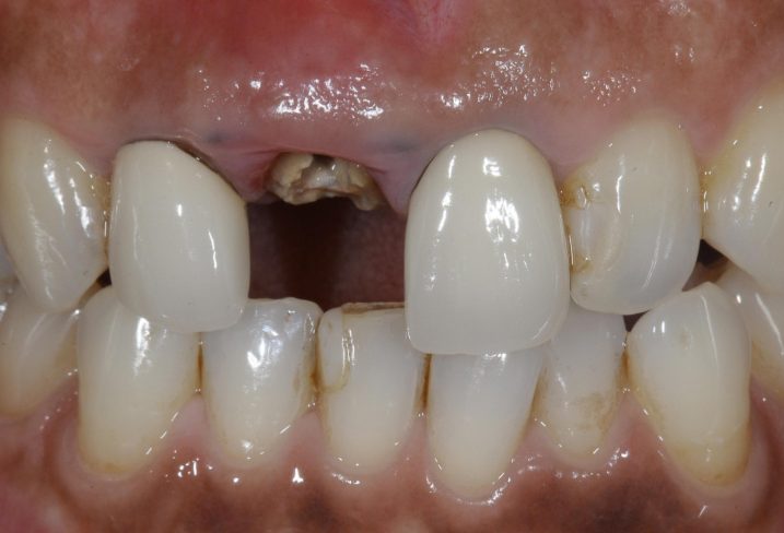 インプラントを行う予定の右上の破折した前歯の被せ物が脱離した写真