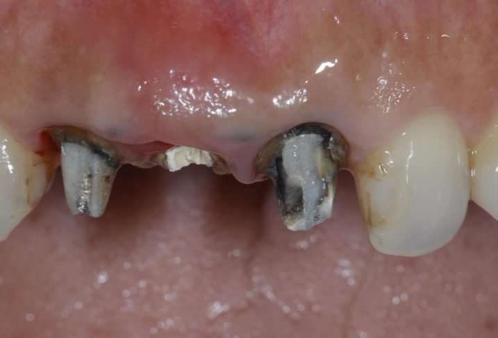 上顎前歯に対して、インプラントの抜歯即時埋入を行なった。
