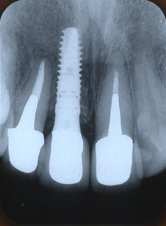 上顎前歯にインプラント、隣の歯はセラミックにて審美歯科治療を行なった。適合状態を確認するために撮影したレントゲン写真