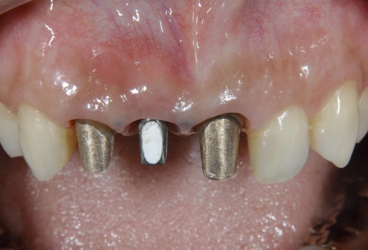 上顎前歯に対して、インプラントの抜歯即時埋入を行なった、隣の歯はセラミックにて審美歯科治療を行う予定であり、歯肉縁下形成を行なった後の写真