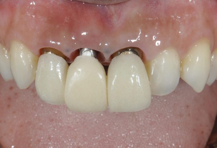 上顎前歯に対して、インプラントの抜歯即時埋入を行なった、隣の歯はセラミックにて審美歯科治療を行う予定であり、歯肉縁下形成を行なった後の写真