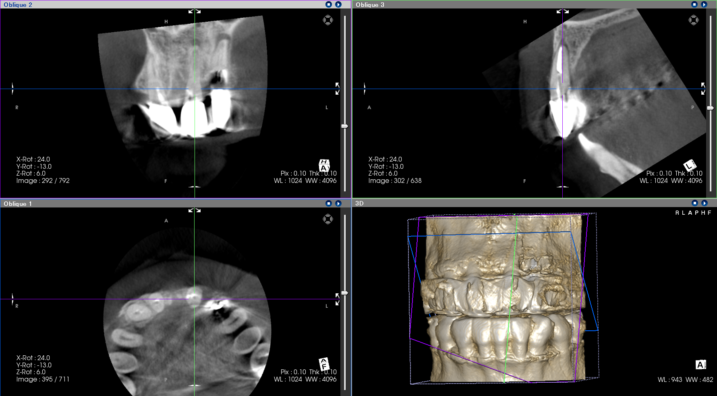 歯根破折の範囲をCT撮影して確認した。