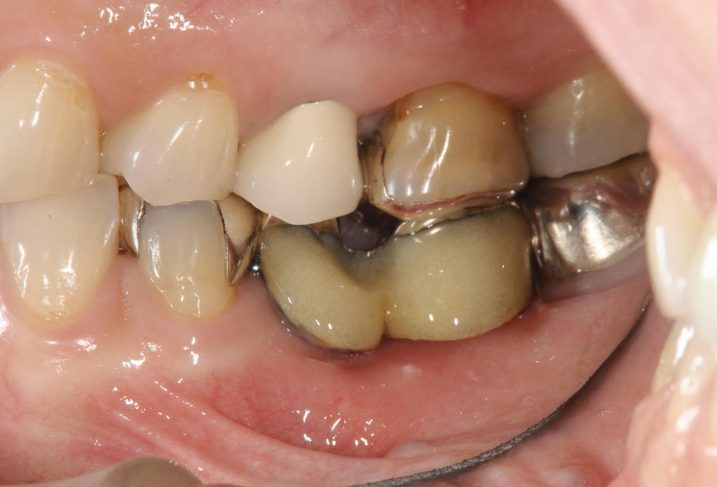 下関市のおおむら歯科医院にて、左下臼歯にインプラントとセラミックの治療を行う前の写真