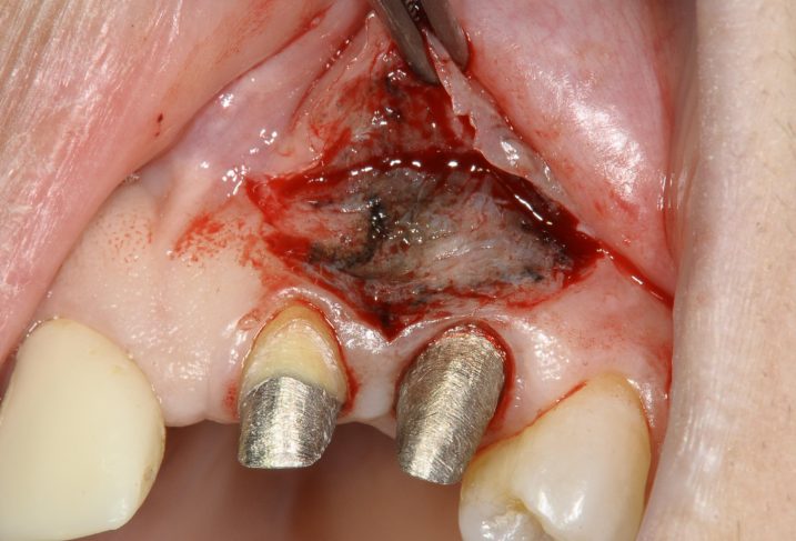 メタルタトゥー除去のために、部分層弁にて歯肉弁を展開