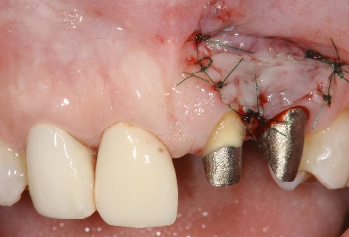 メタルタトゥー除去のために、部分層弁にて歯肉弁を展開、除去した後に縫合