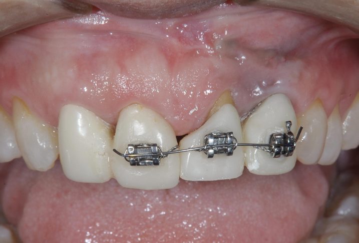 歯肉の位置、歯頸線を整えるために矯正を行なった。