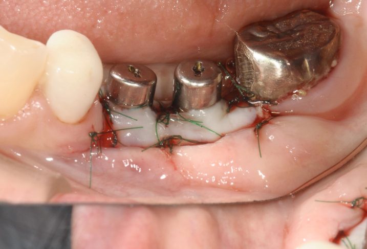 下関市のおおむら歯科医院にて、左下臼歯にインプラントの二次手術を行なった際の写真。グラフト手術も併用し、付着歯肉幅の増大も狙った。