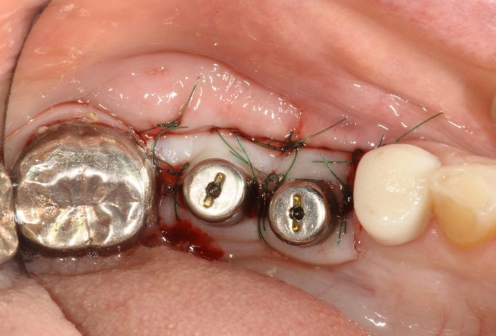下関市のおおむら歯科医院にて、左下臼歯にインプラントの二次手術を行なった際の写真。グラフト手術も併用し、付着歯肉幅の増大も狙った。（咬合面観）