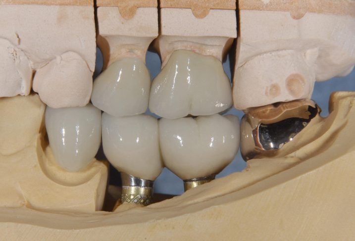 下関市のおおむら歯科医院にて治療した、左上臼歯のセラミック、左下臼歯のインプラントのセラミックの模型。