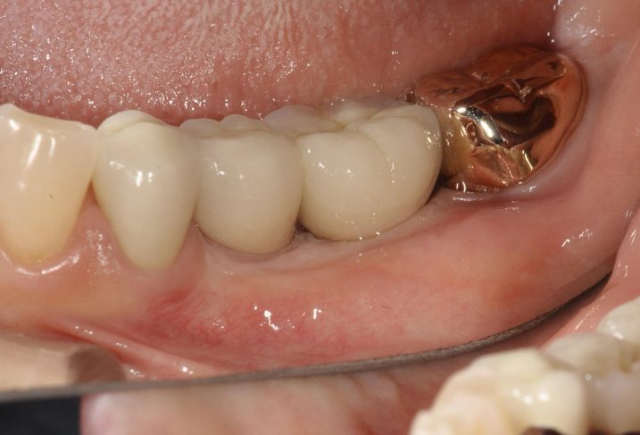 下関市のおおむら歯科医院にて、左下臼歯にインプラントとセラミックの治療を行った後の写真
