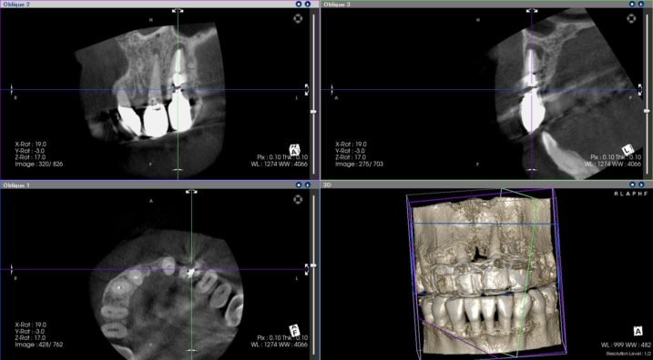 下関市のおおむら歯科医院にてセラミック治療の診断のために撮影したCT