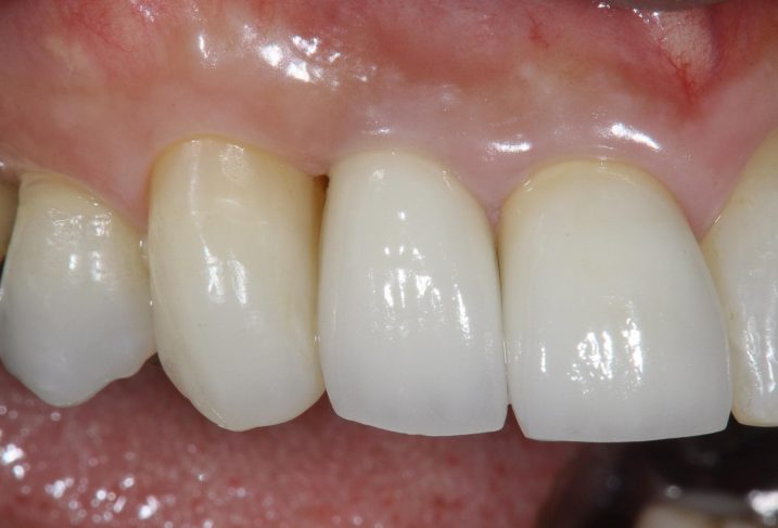 右上１２と左上２のセラミッククラウンの治療、ホワイトニングも行なった治療後の写真。右上2番の拡大。歯茎の形もシャープになった。