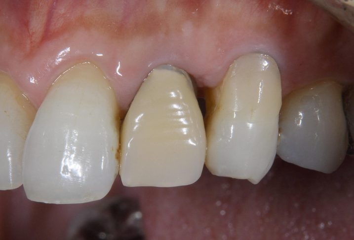 初診時の写真。（左側）歯茎が下がってしまっている。