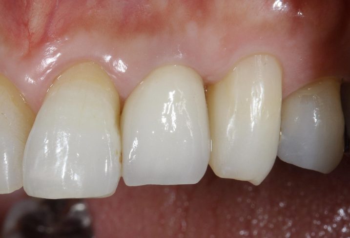 右上１２と左上２のセラミッククラウンの治療、ホワイトニングも行なった治療後の写真。左上2番の拡大。歯茎の形もシャープになり、ブラックトライアングルも埋まっている。