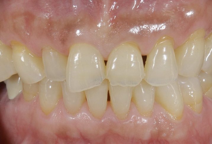 酸蝕歯の写真。これからセラミック冠を用いて形態の回復を行う。