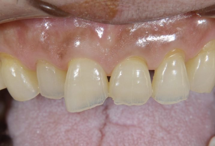 酸蝕歯の写真。これからセラミック冠を用いて形態の回復を行う。（上顎正面観）