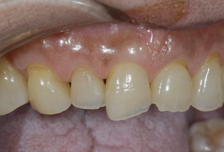 酸蝕歯の写真。これからセラミック冠を用いて形態の回復を行う。（右側方観）