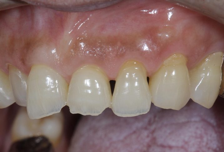 酸蝕歯の写真。これからセラミック冠を用いて形態の回復を行う。（左側方観）