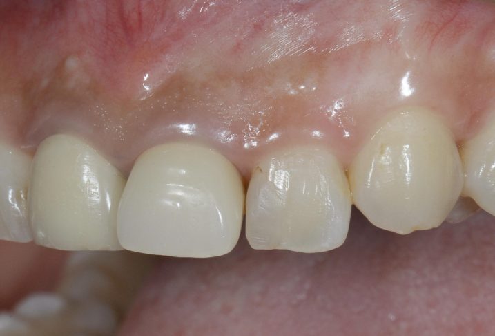 上顎前歯部にセラミック治療を行う前の写真。歯並びが乱れている。（側方から撮影）
