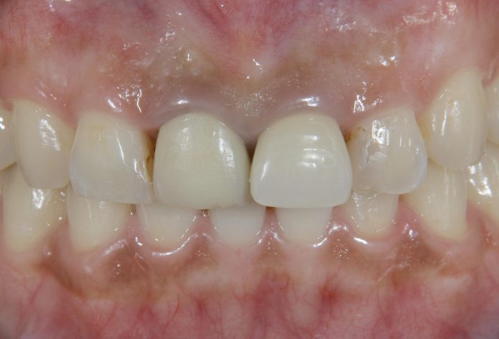 上顎前歯部にセラミック治療を行う前の写真。歯並びが乱れている。