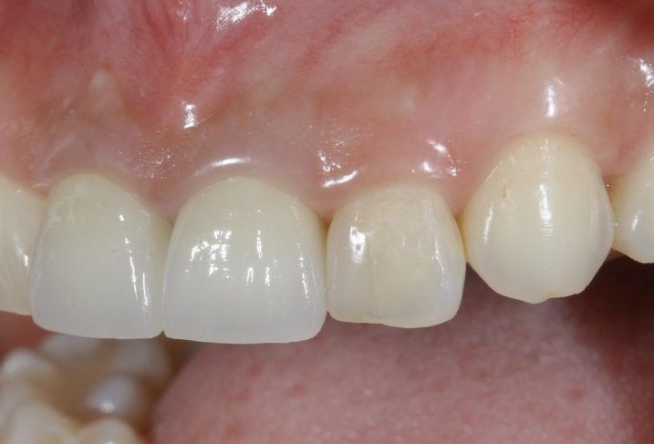 上顎前歯部にセラミック治療・歯茎の色素除去を行った後の写真。乱れた歯並びも大きく改善し、歯茎の色も健康的に仕上がった。（側方から撮影）