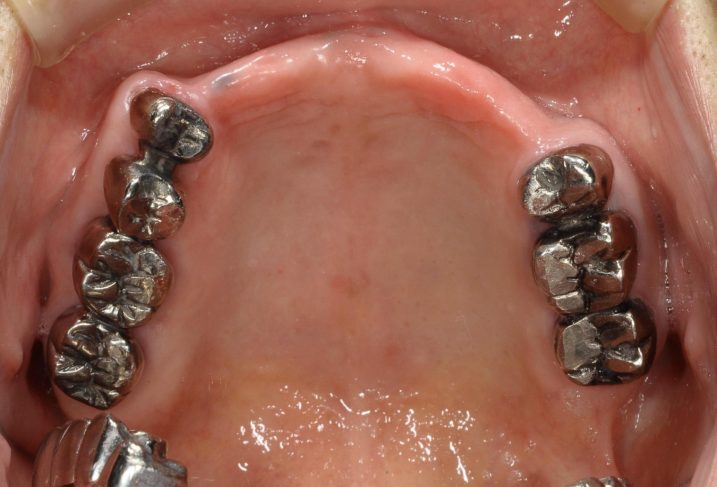 インプラント　義歯　の治療を行う前の写真（義歯を外した状態　上顎　咬合面）