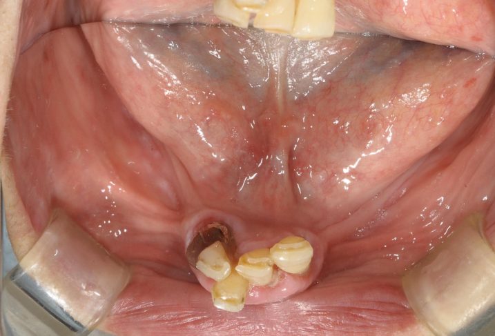 インプラント　義歯　の治療を行う前の写真（義歯を外した状態　下顎　咬合面）