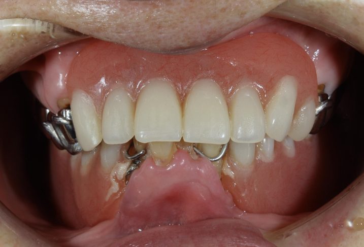 症例54 難易度の高い「すれ違い咬合」の義歯治療 | 下関 おおむら歯科医院の症例ブログ「日々是臨床・百聞は一見に如ず」（審美歯科、インプラント、歯 周病治療、セカンドオピニオンなど）