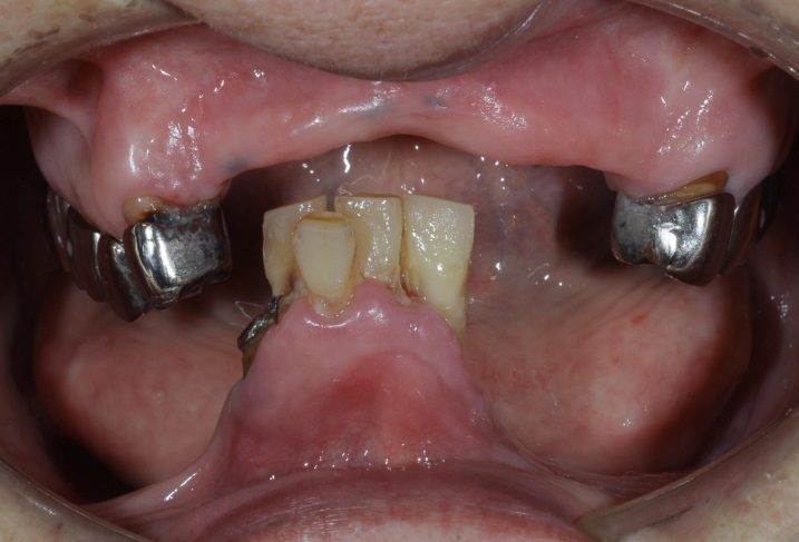 インプラント　義歯　の治療を行う前の写真（義歯を外した状態）