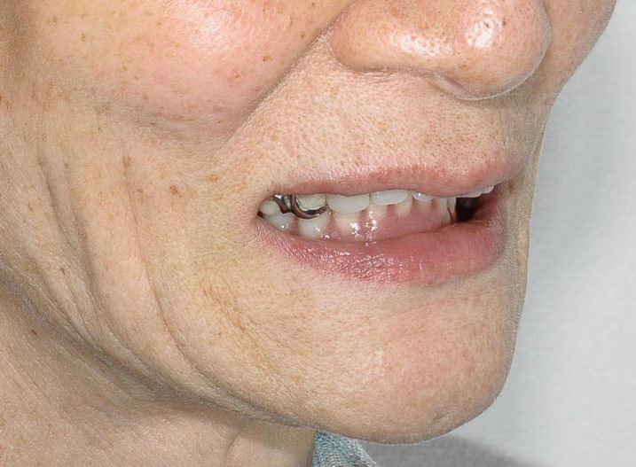 インプラント　義歯　の治療を行う前の顔貌写真（微笑）入れ歯の金具が見えてしまう。