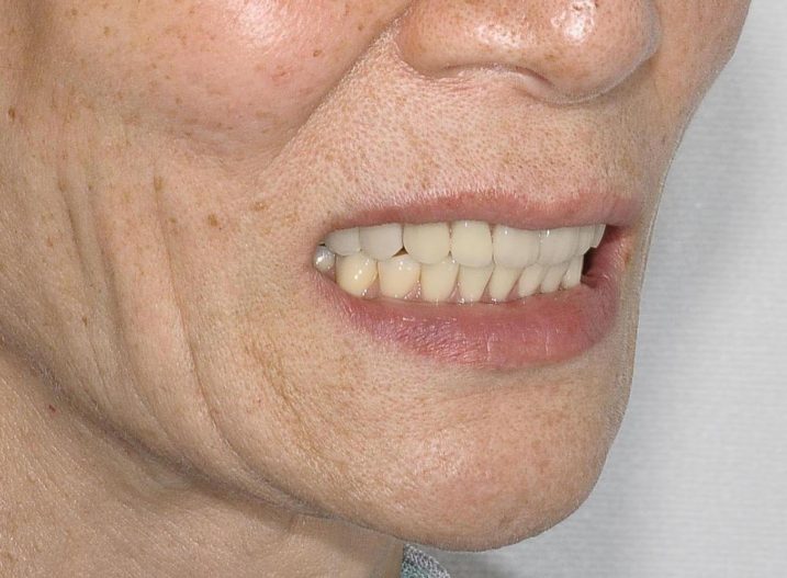 インプラント　義歯　の治療を行なった後の顔貌写真（微笑）入れ歯の金具は見えず、審美的な仕上がりとなった。