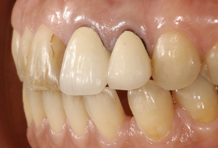 セラミック治療を行う前の写真、歯の幅が不揃いである。