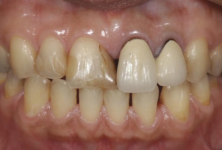セラミック治療を行う前の写真、歯の幅が不揃いである。